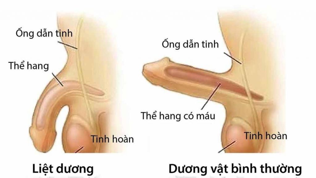 Rối loạn cương dương là gì?