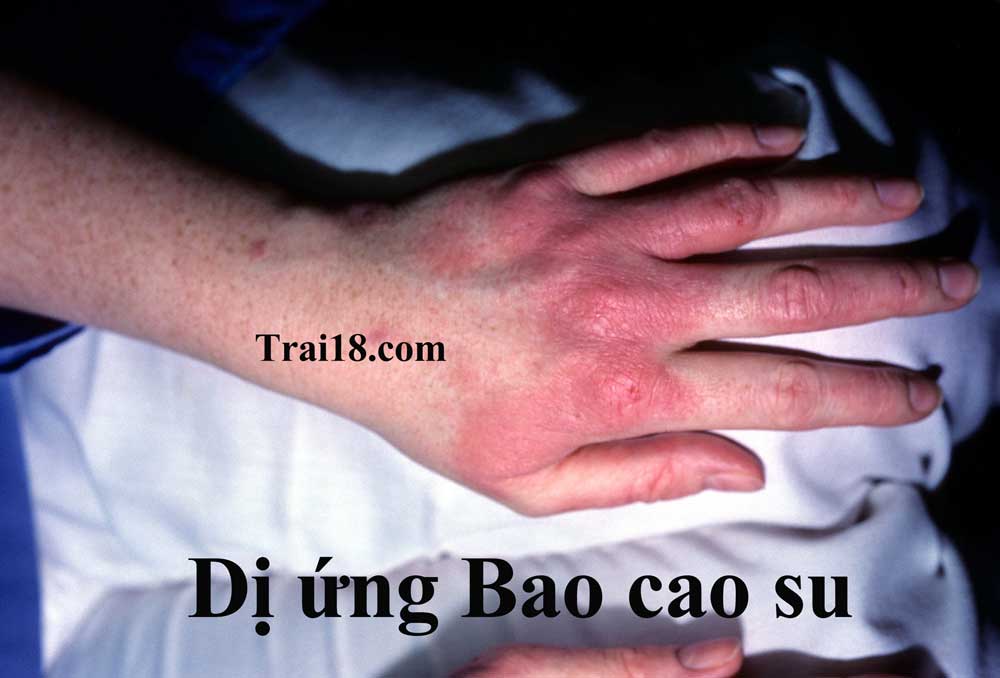 dị ứng bao cao su