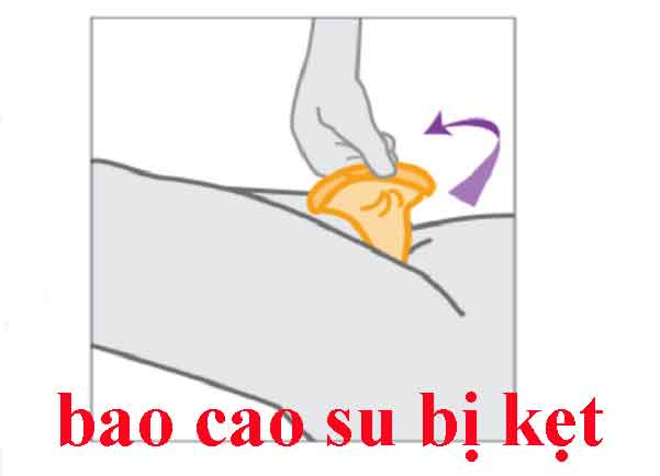 Hình ảnh tháo bao cao su dính ở mép âm đạo